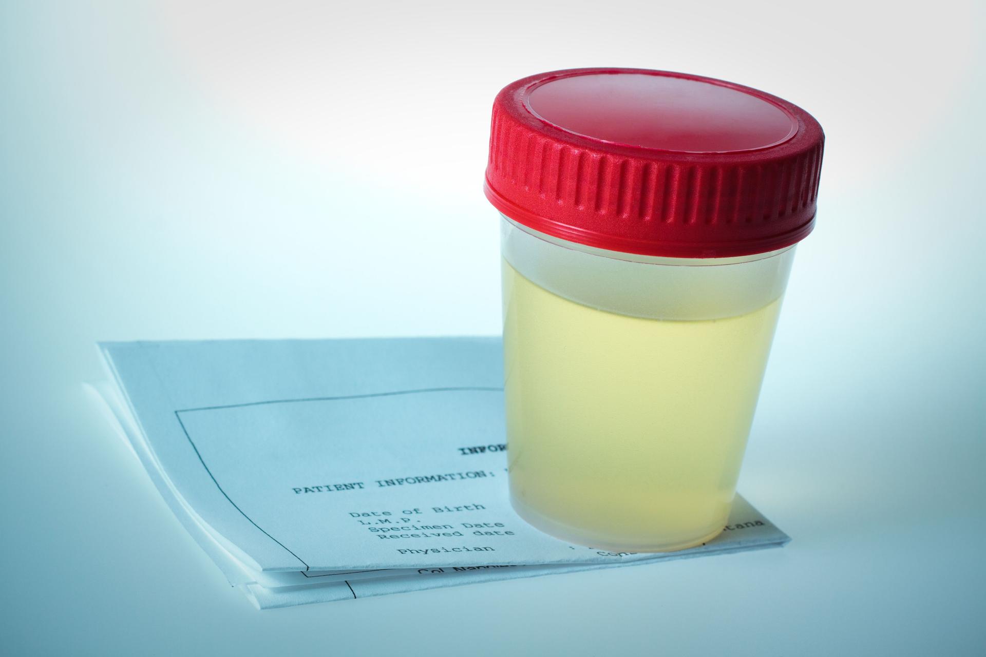 Urine test results