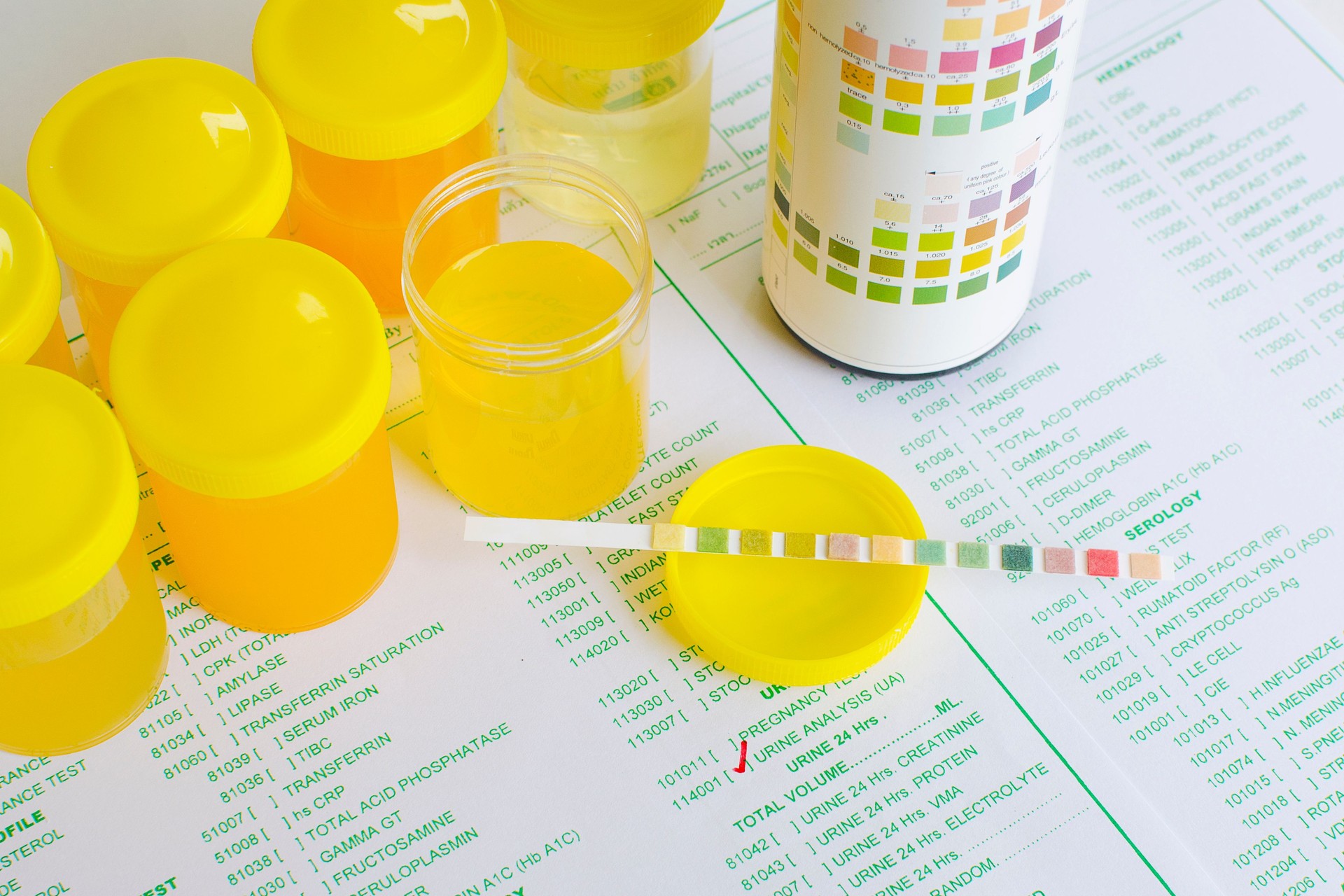 Urine analysis